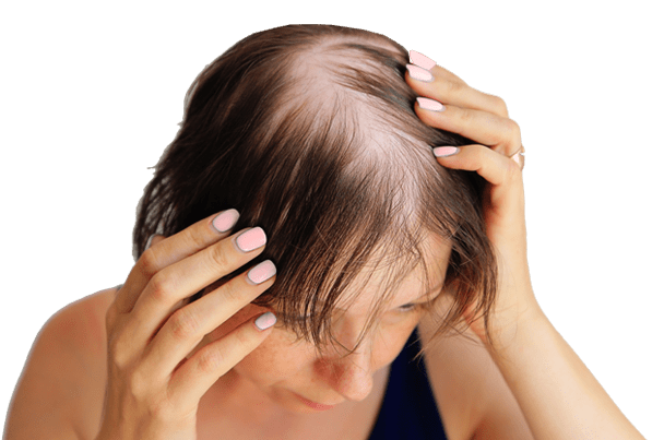 Balding lady losing hair in despair - treat your thinning and balding hair issues with Gummbear's "Grow Hair Grow - Hair Vitamin Gummies" fortified with 5,000mcg Biotin