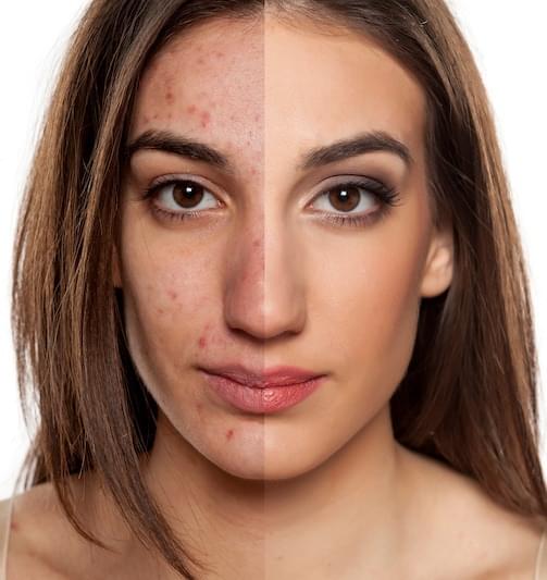 GummBear Advanced Hair Skin And Nails Gummies - Before After Photos of Comedonal Face Acne Blackheads Whiteheads Treatment With Vitamin B7 Biotin